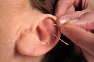 ACUPUNTURA AURICULAR