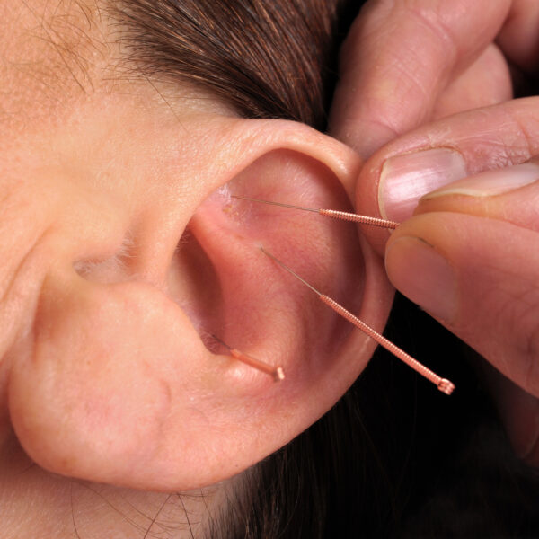 ACUPUNTURA AURICULAR