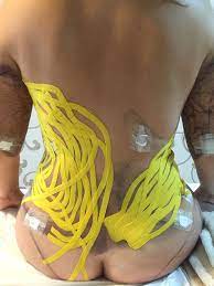 TAPING TERAPÊUTICO E ESTÉTICO - Image 6